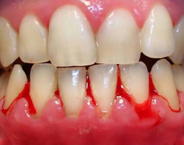 Stop Bleeding and Inflamed Gums with These Easy Solutions